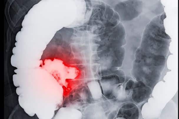 imagerie diagnostic cancer du colon